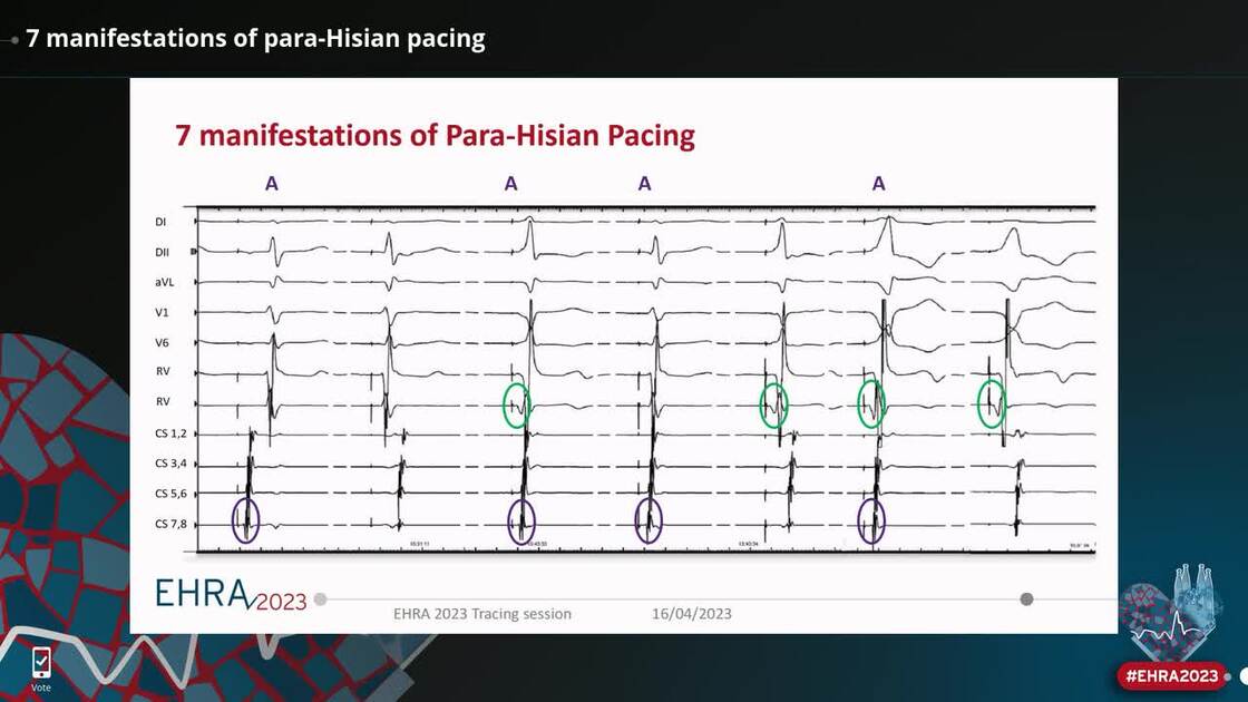 ESC 365 7 Manifestations Of Para Hisian Pacing