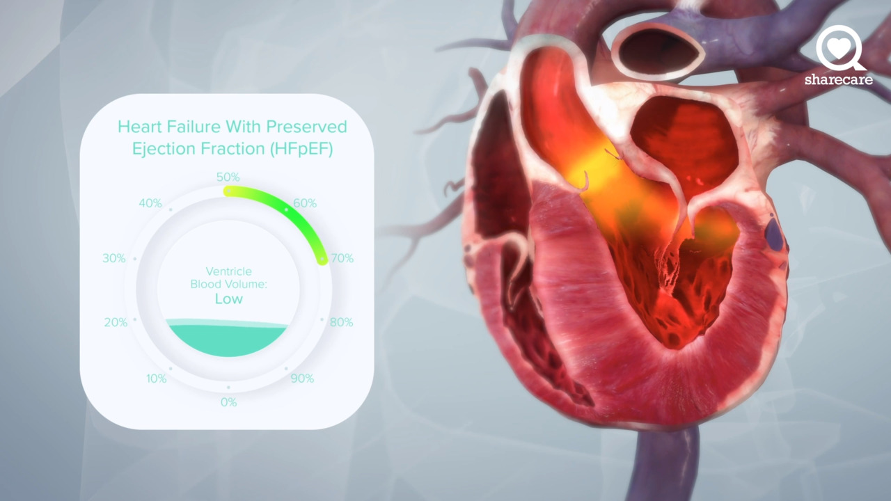 A Virtual Look at What Causes Heart Failure