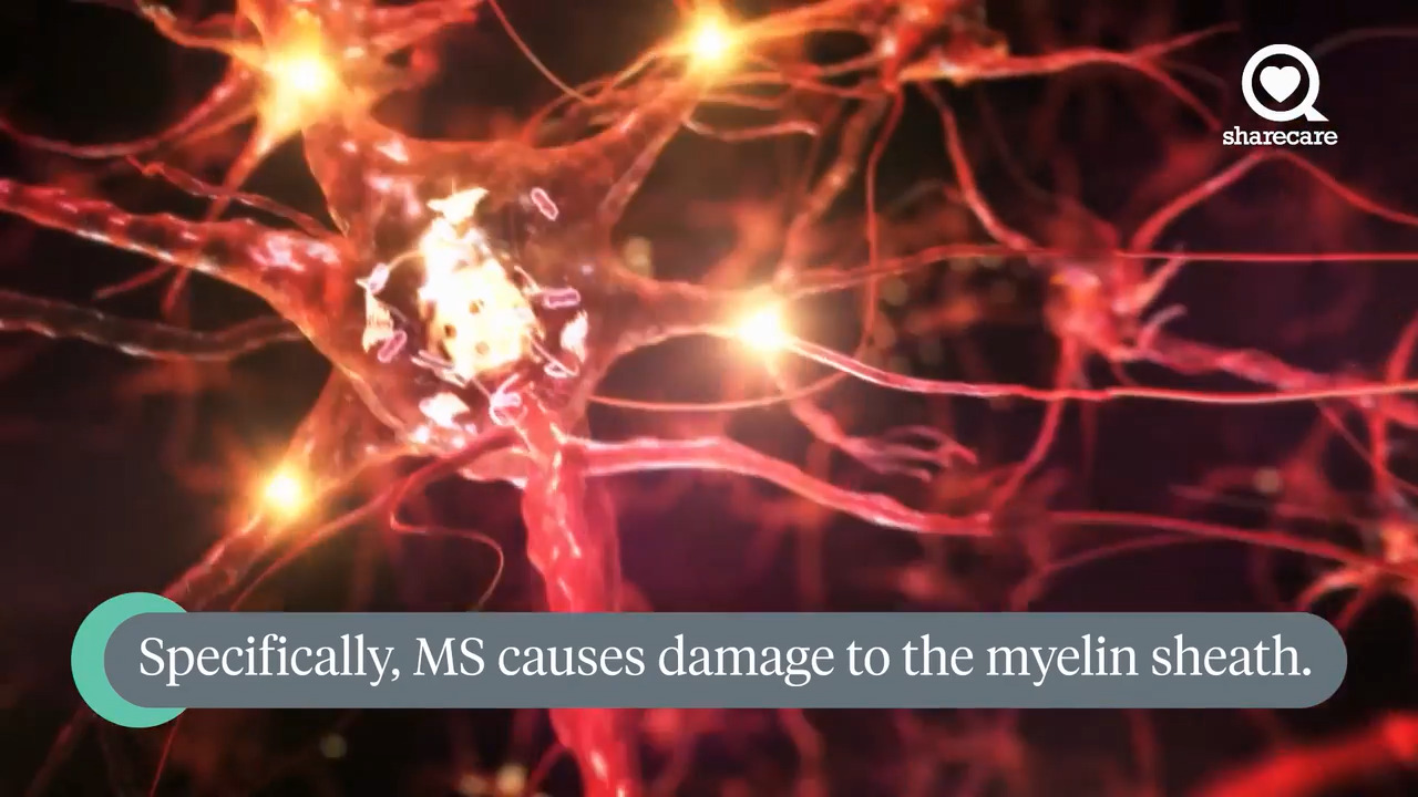 The Importance of Early Treatment for MS 