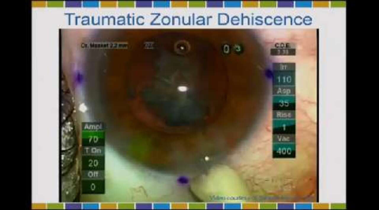 video: management of zonular dehiscence