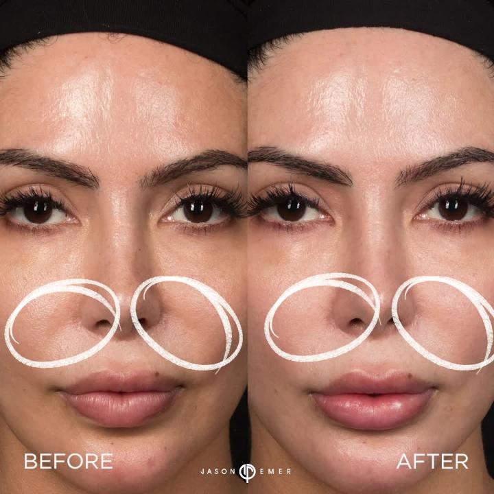 Instalift Silhouette Threads Non Surgical Face Lift Before After