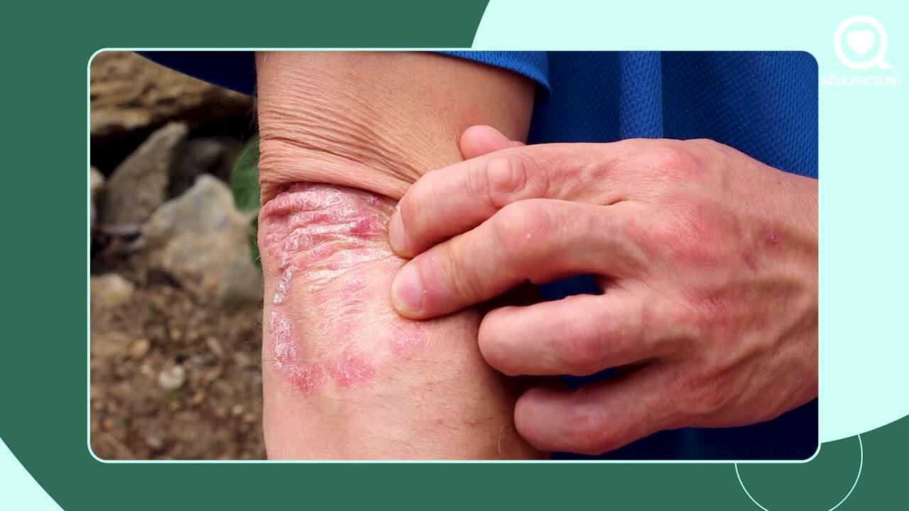 What is the difference between psoriatic arthritis and gout?