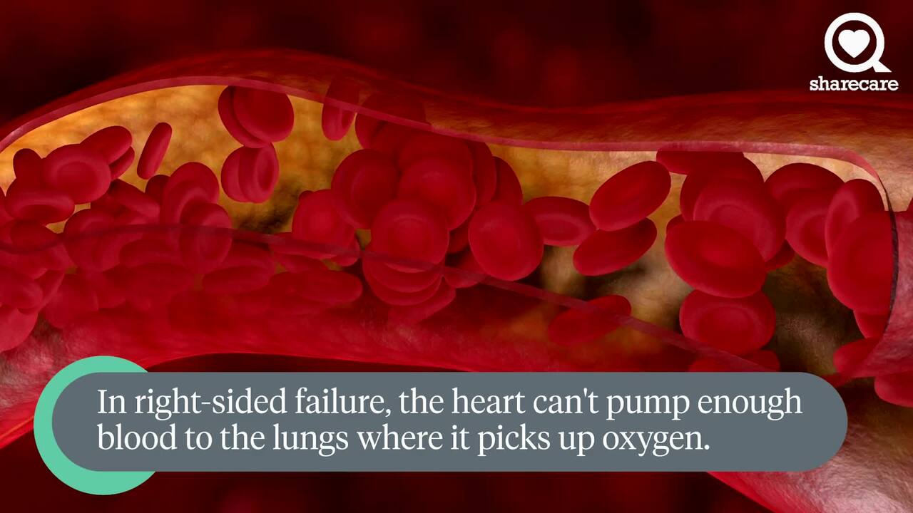 Understanding the symptoms of left- and right-sided heart failure