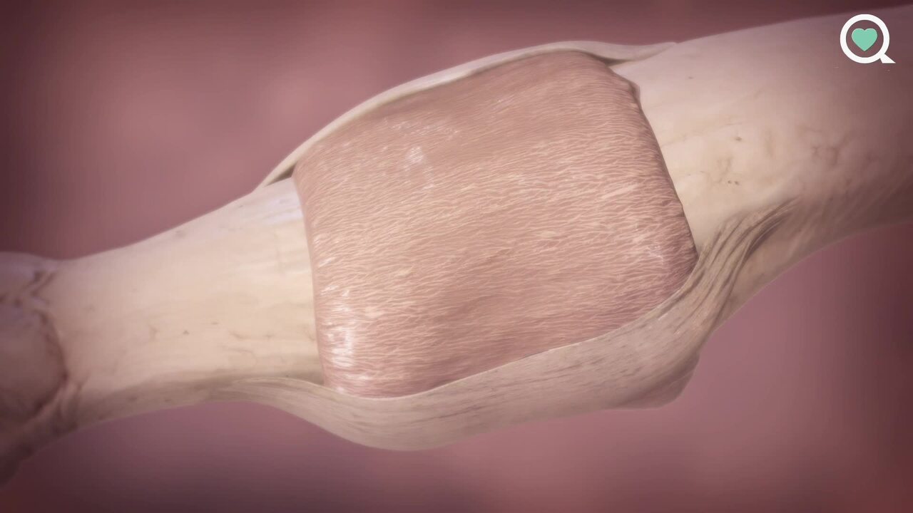 A Virtual Look at Psoriatic Arthritis With Dr. Caudle