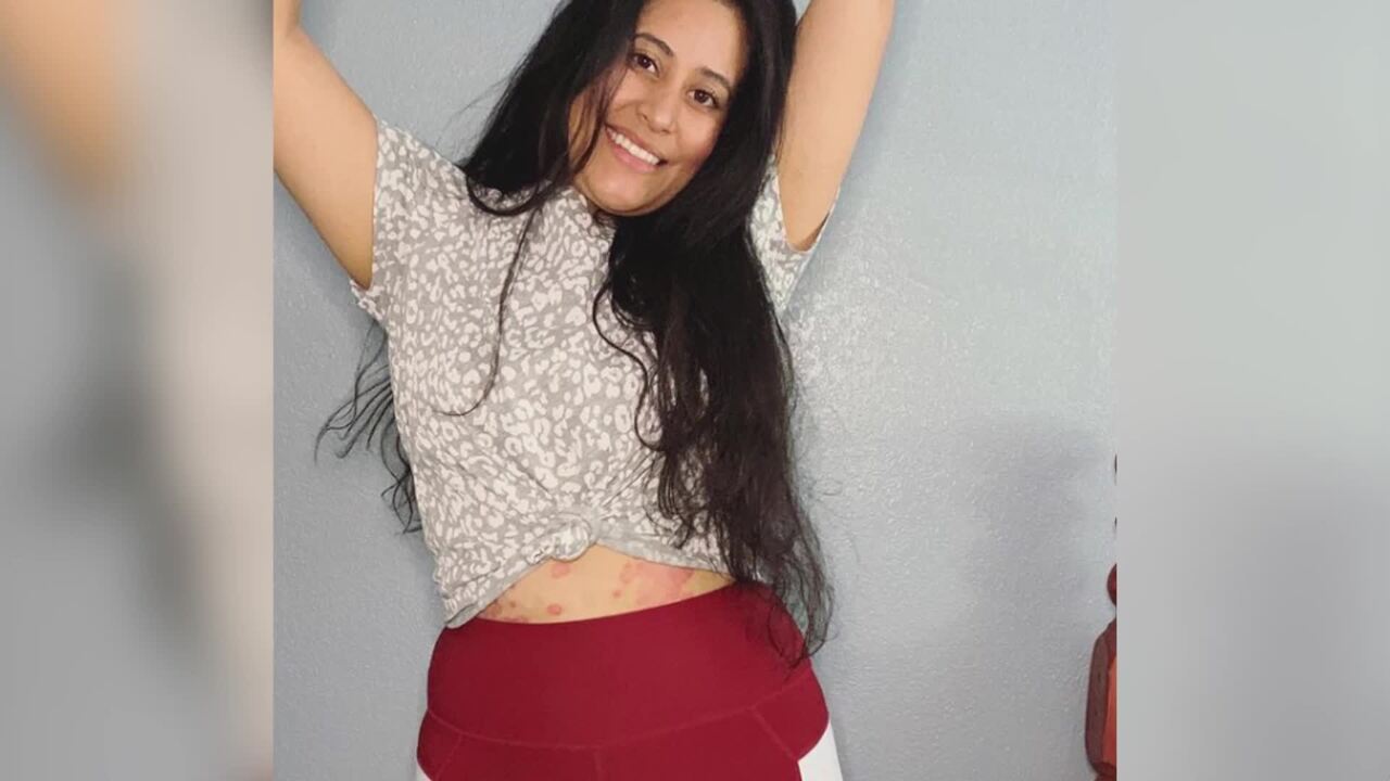 My story: blanca's experience with psoriasis