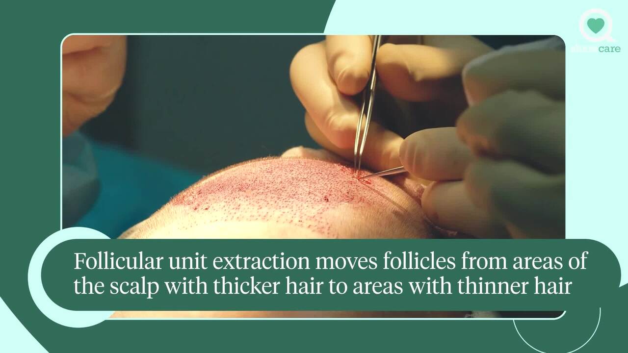 What is the Neograft method for hair transplant procedures?
