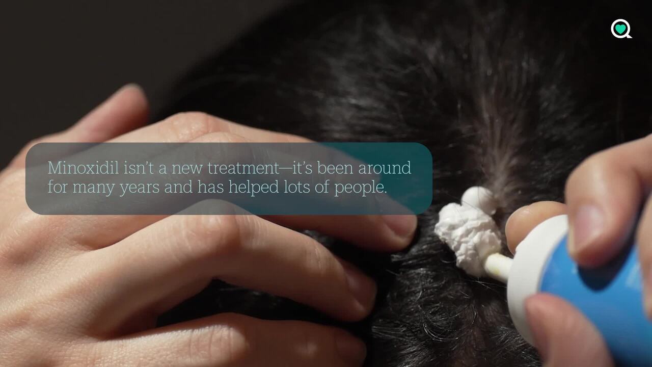 Minoxidil may be an inexpensive treatment for hair loss