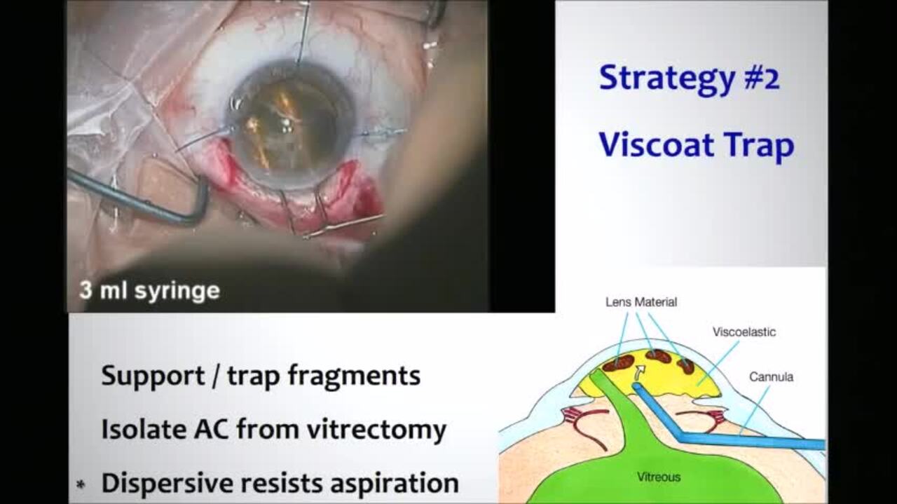 Cataract Surgery Video