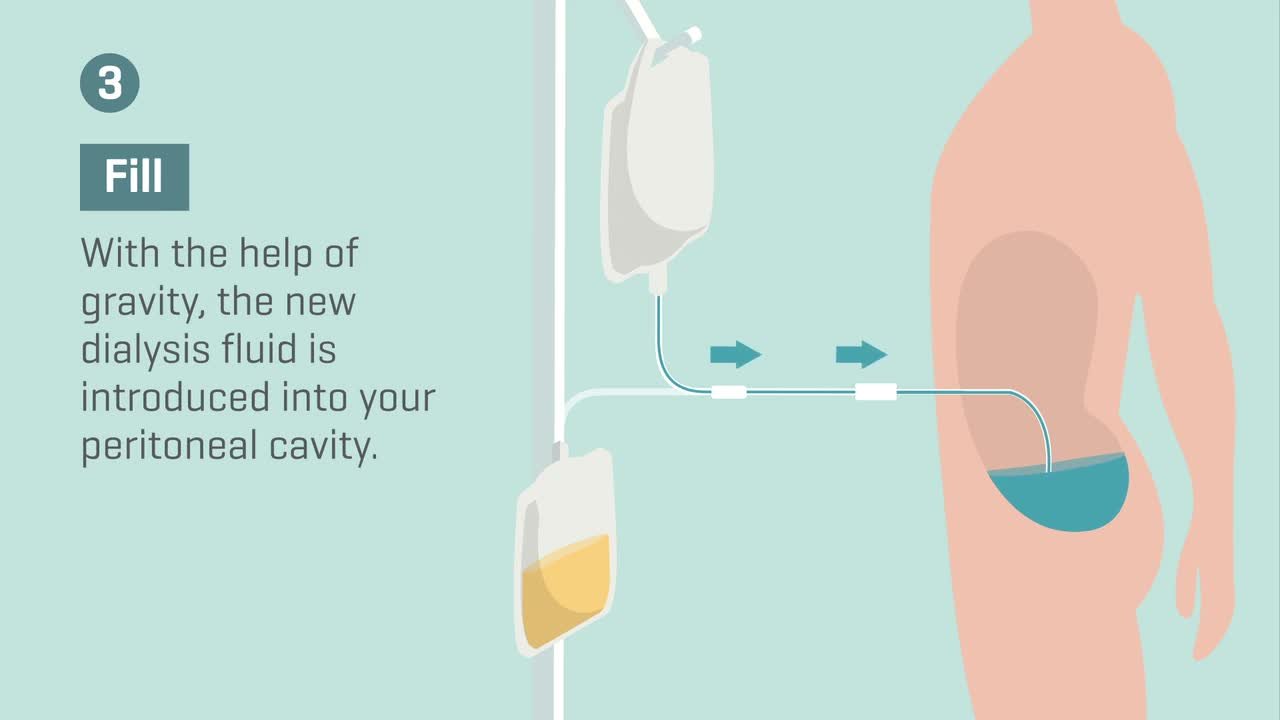 Continuous Ambulatory Peritoneal Dialysis Capd Komunitas Pasien