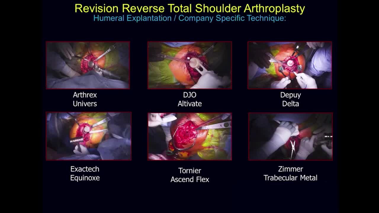 08.06.24-EST-Video-Revising Failed Reverse Total Shoulder Arthroplasty ...