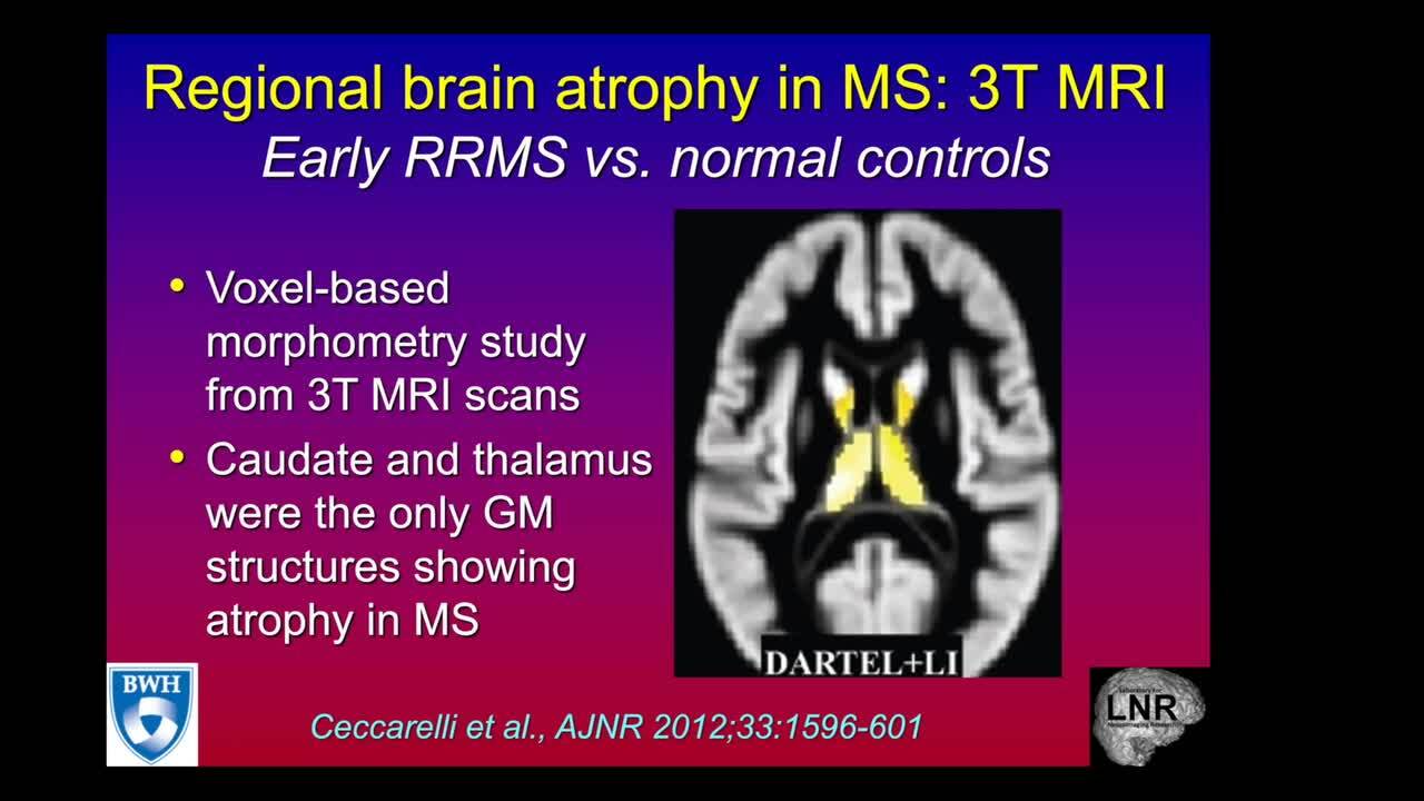 MRI in Multiple Sclerosis