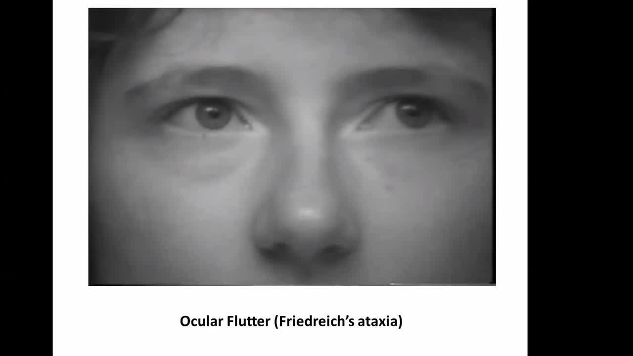 Approach to Nystagmus and Related Eye Movements