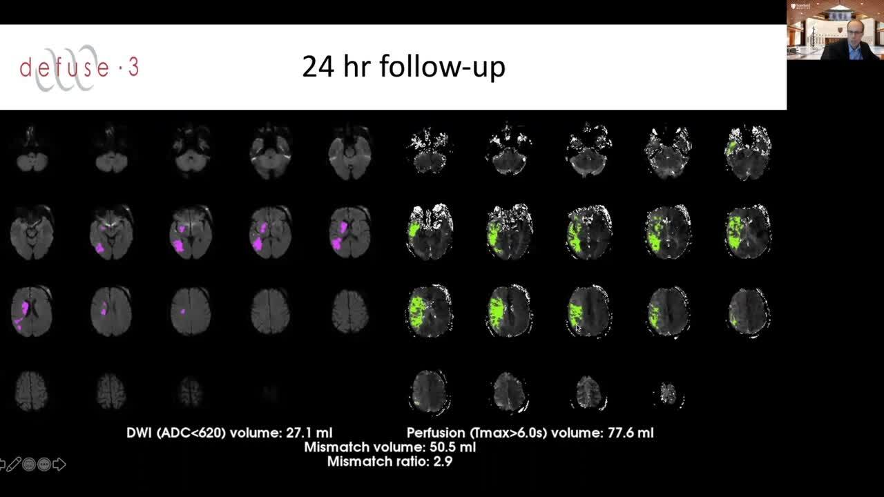 Image-Based Patient-Selection for Acute Stroke Therapy