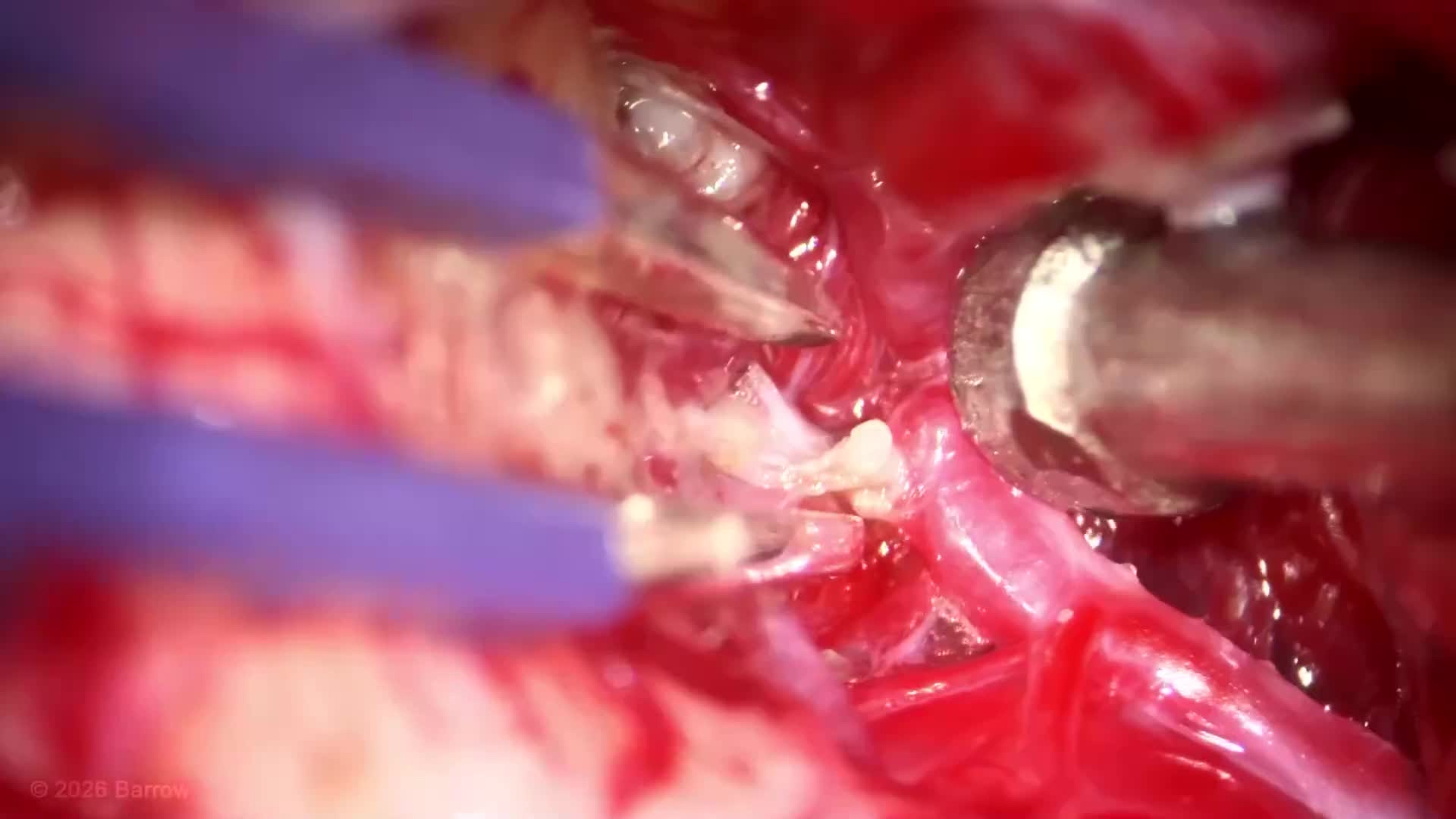 #562: Bifrontal Craniotomy and Transsulcal Resection of a Precentral Sulcus Premotor Arteriovenous Malformation