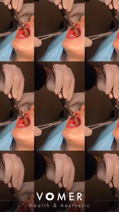 How Is Bichectomy Buccal Fat Removal Performed Video Realself