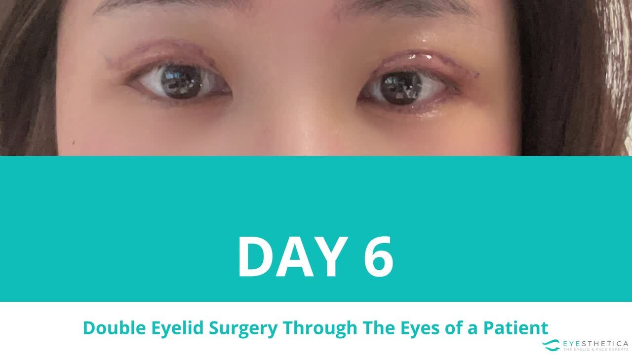 Double Eyelid Video Realself