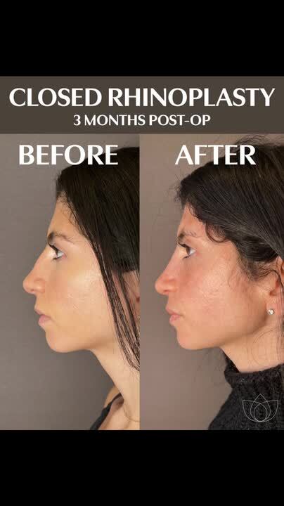 3 Months post Closed Scarless Rhinoplasty