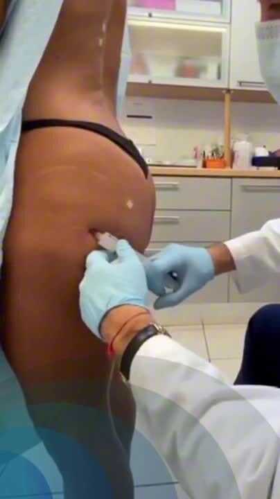 Non Surgical Butt Lift With Pdo Treads And Sculptra Video Realself