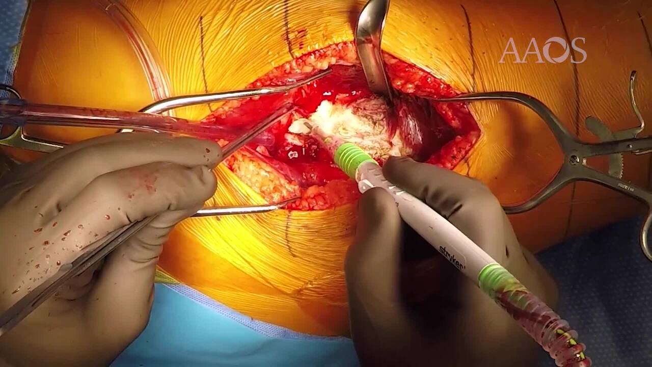 Hip Anatomy Video, Hip Orthopaedics Videos