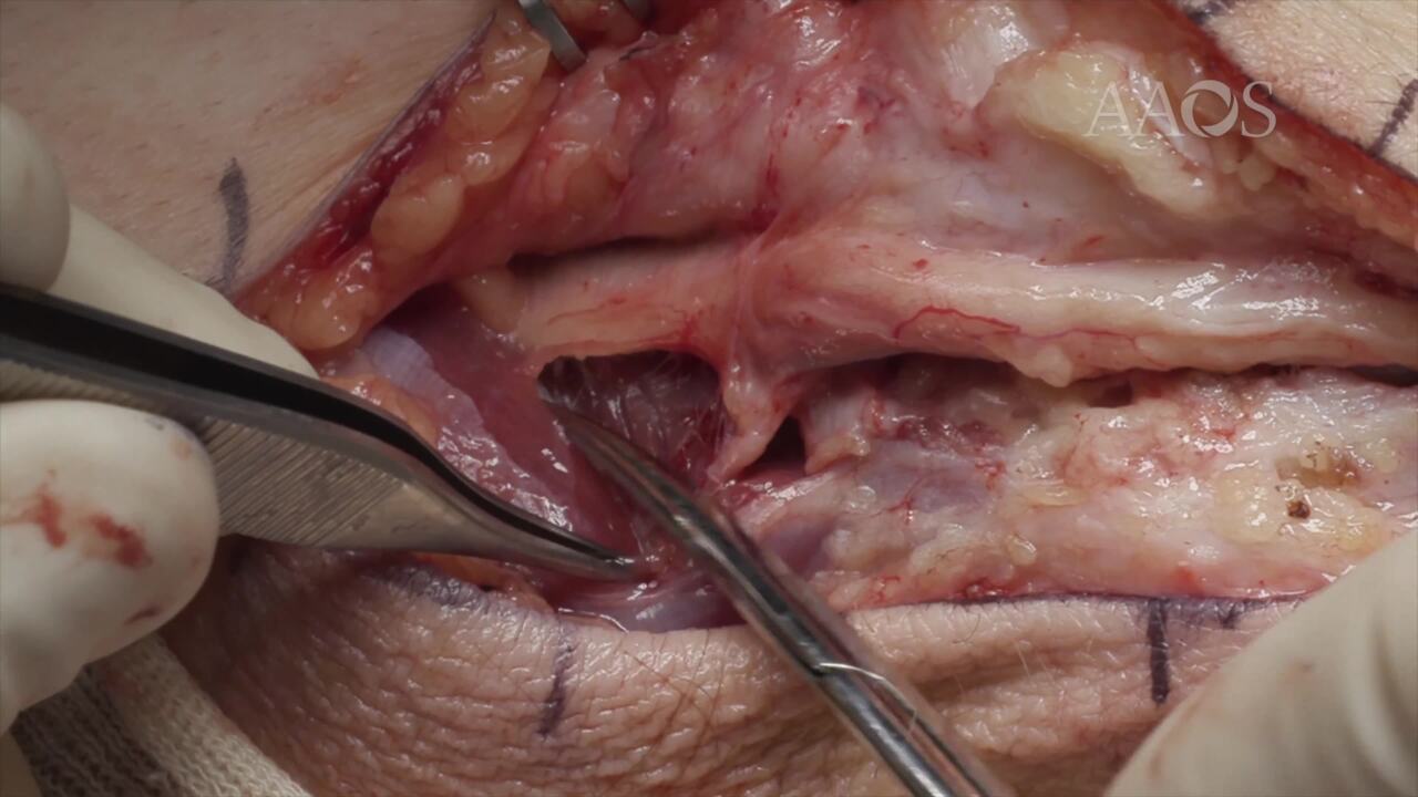 Professional Ulnar Nerve Transposition Surgery