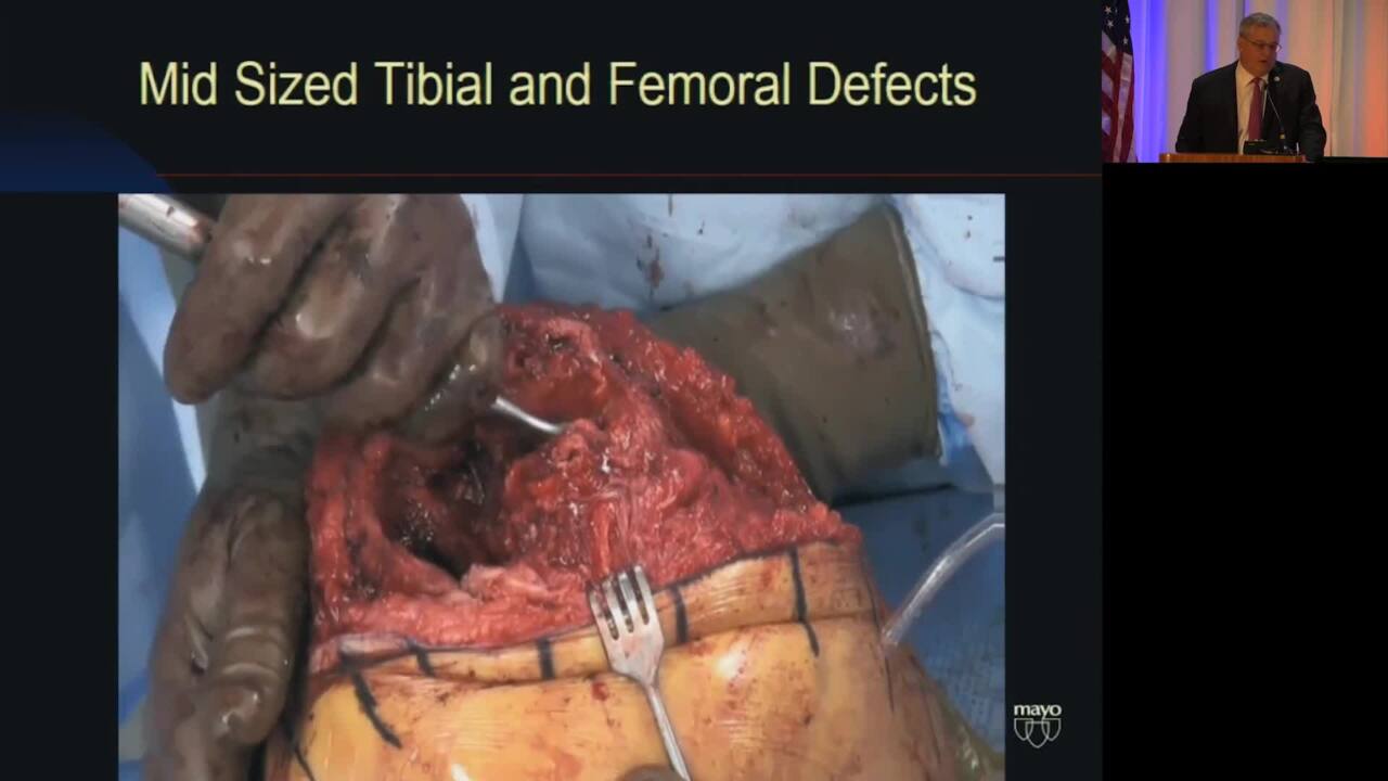Bone Defect Management- Femoral and Tibial Metaphyseal Cones