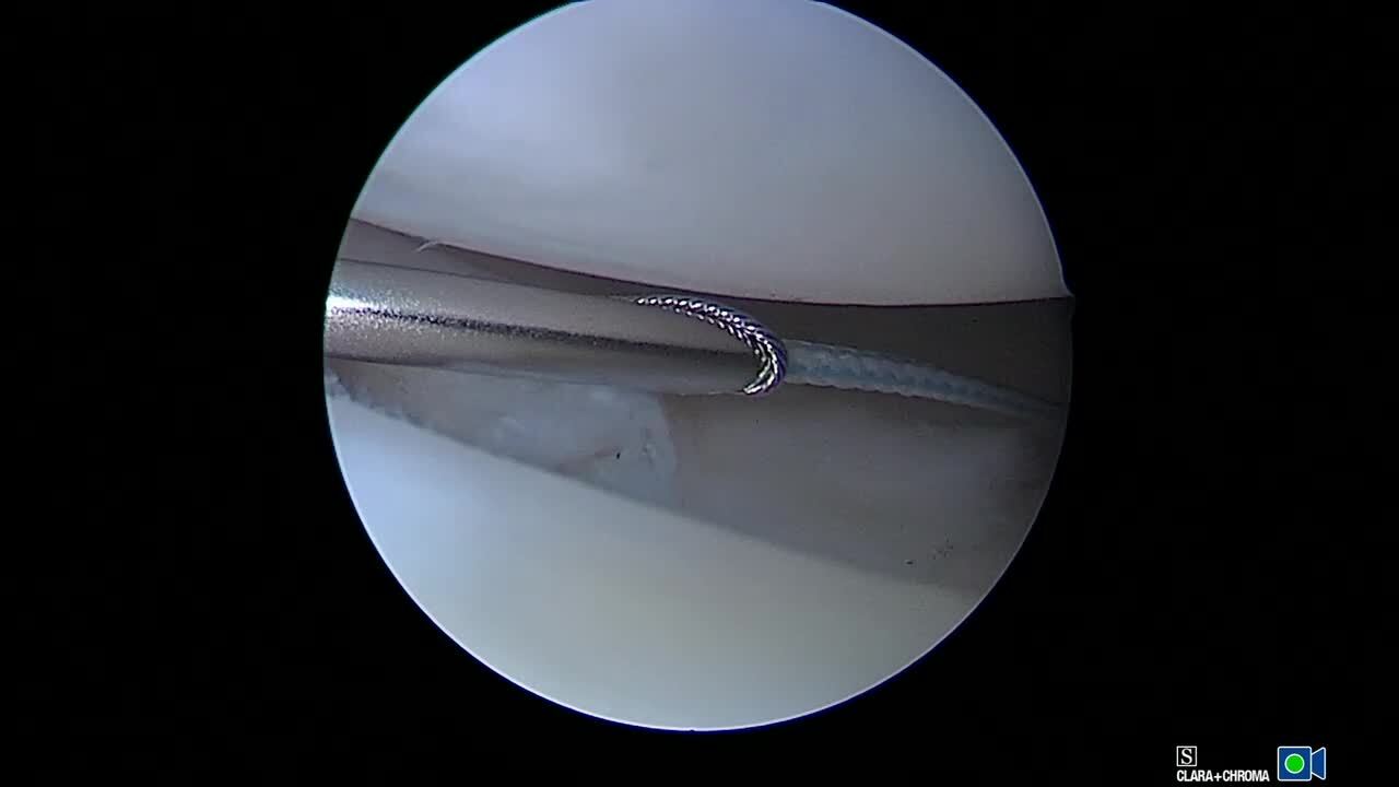 Desgarros de los meniscus (Meniscus Tears) - OrthoInfo - AAOS
