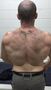 Retraction - Scapular Medial Translation