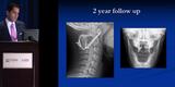 Atlantoaxial Rotatory Instability