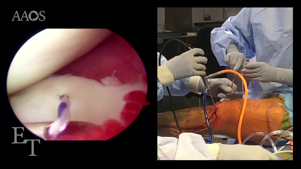 Repairing Bucket-Handle Medial Meniscal Tears by Using an Inside-Out Technique Without a Safety Incision