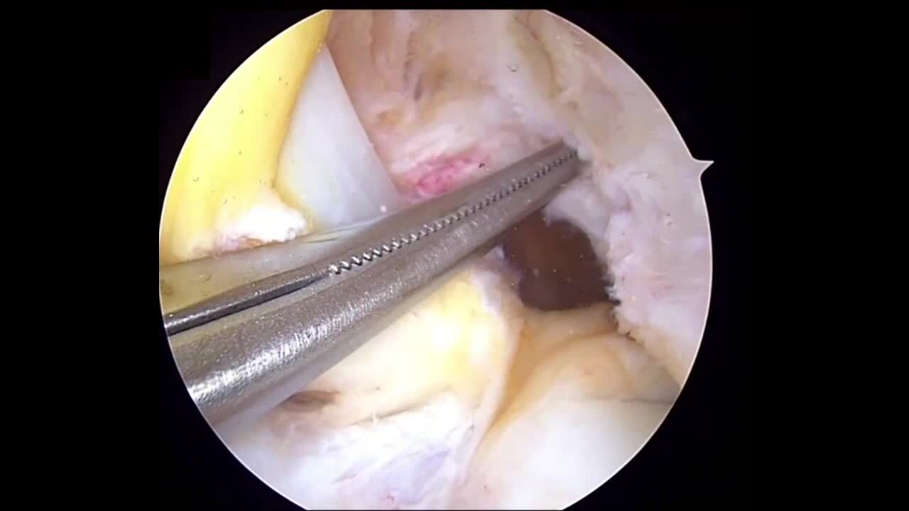 Femoral Physeal-Sparing Anterior Cruciate Ligament Reconstruction With Iliotibial Band Autograft Over-the-Top With Associated Lateral Extra-Articular Tenodesis Technique