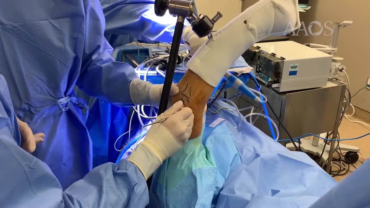 Suparma File Surgery Video Details