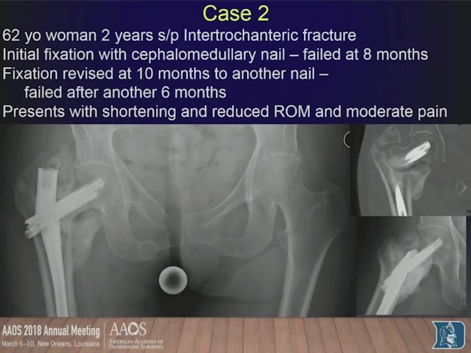 Managing Complications in Fractures of the Hip: Strategies Before Arthroplasty