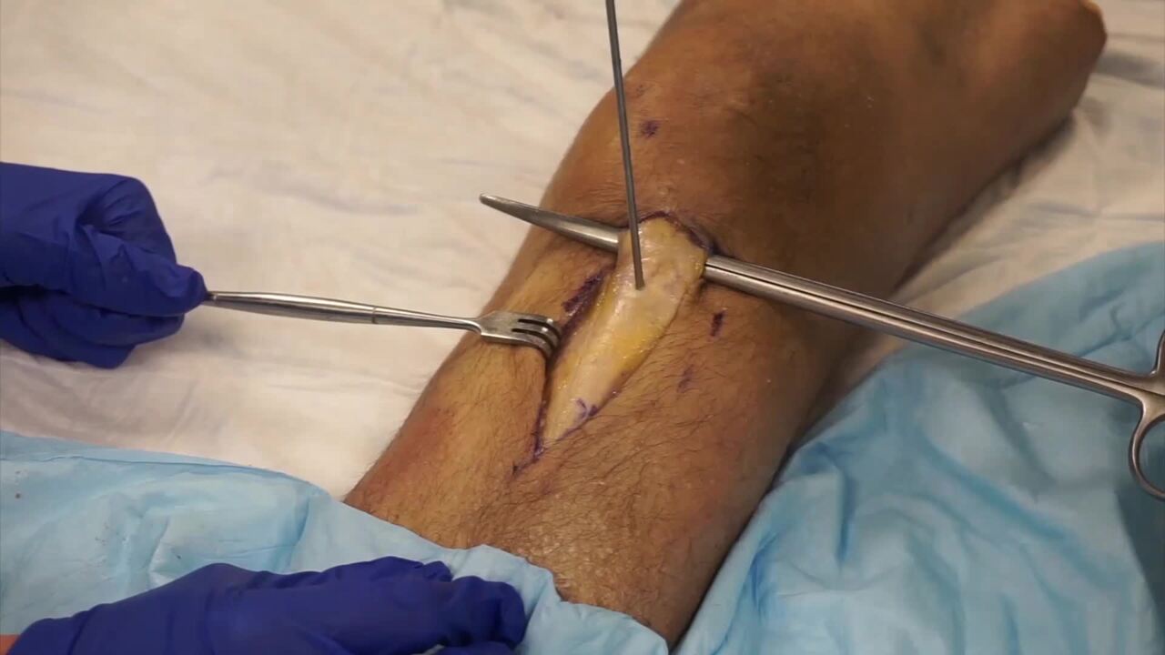 Indications and Technique: Tibial Tubercle Osteotomies