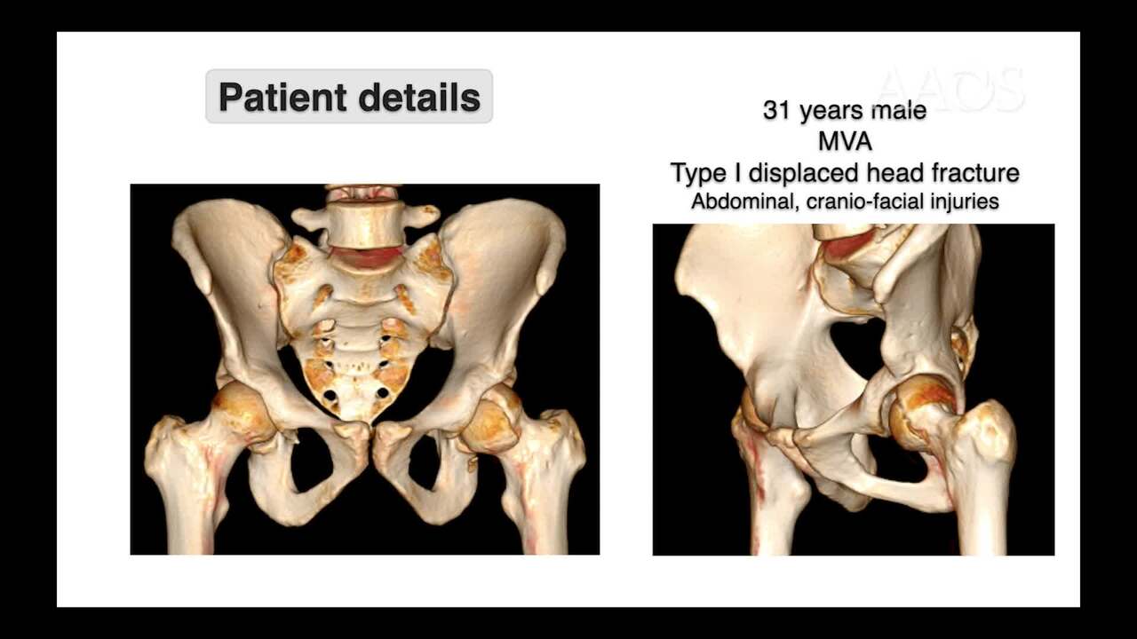 AAOS OVT - Safe Surgical Dislocation or the Modified Heuter Anterior  Approach for Pipkin Type I and II Femoral Head Fractures?