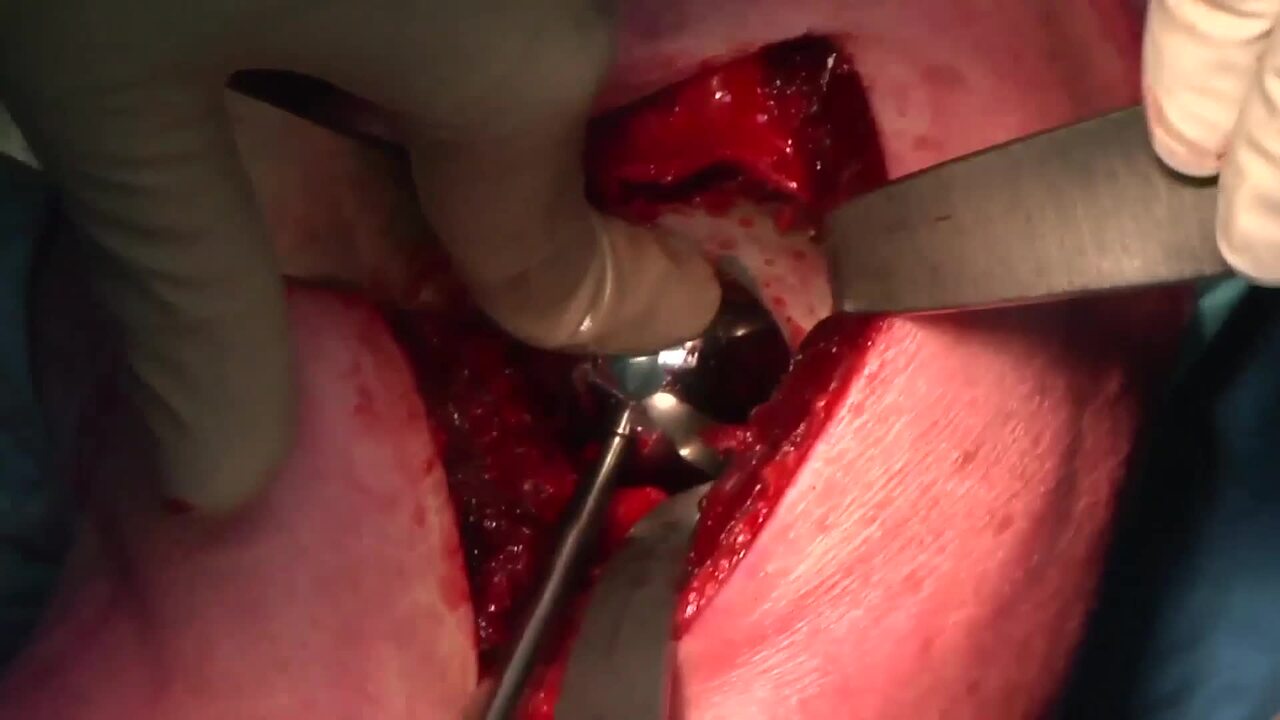 Reverse Total Shoulder Replacement Surgical Video - OrthoInfo - AAOS