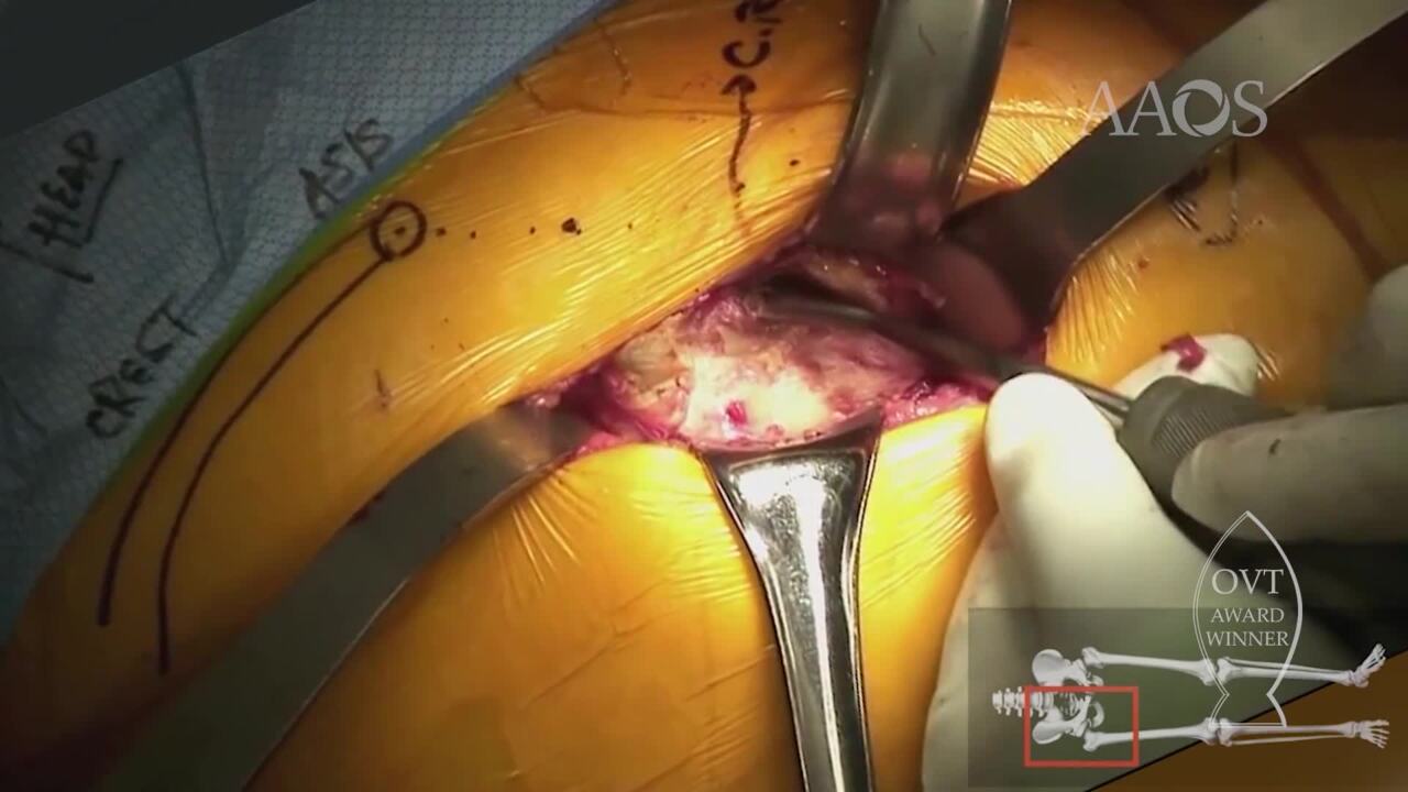 Direct Anterior Approach for Hip Hemiarthroplasty