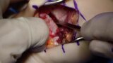 Distal Radius Malunion Volar Opening Wedge Osteotomy