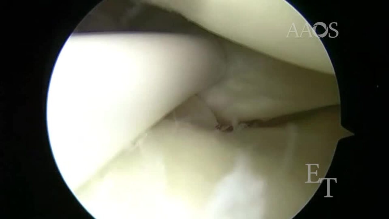 All-Inside Repair of Radial Meniscus Root Tears