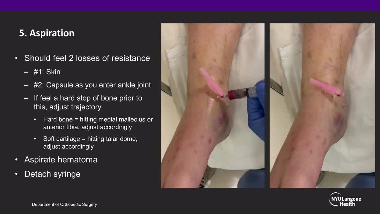 AAOS OVT - Anteromedial Ankle Hematoma Block