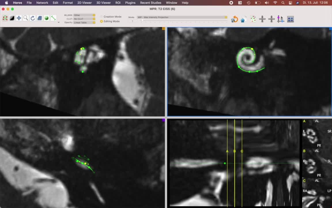 Cochlear Duct Length Radiology