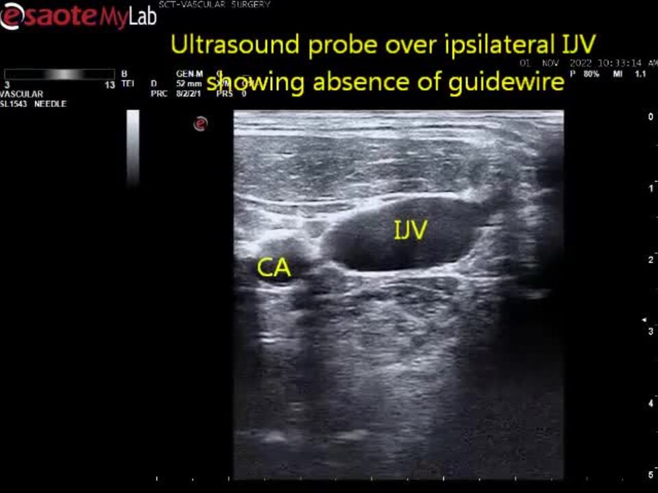 Intraoperative ipsilateral subclavian port catheter implantation