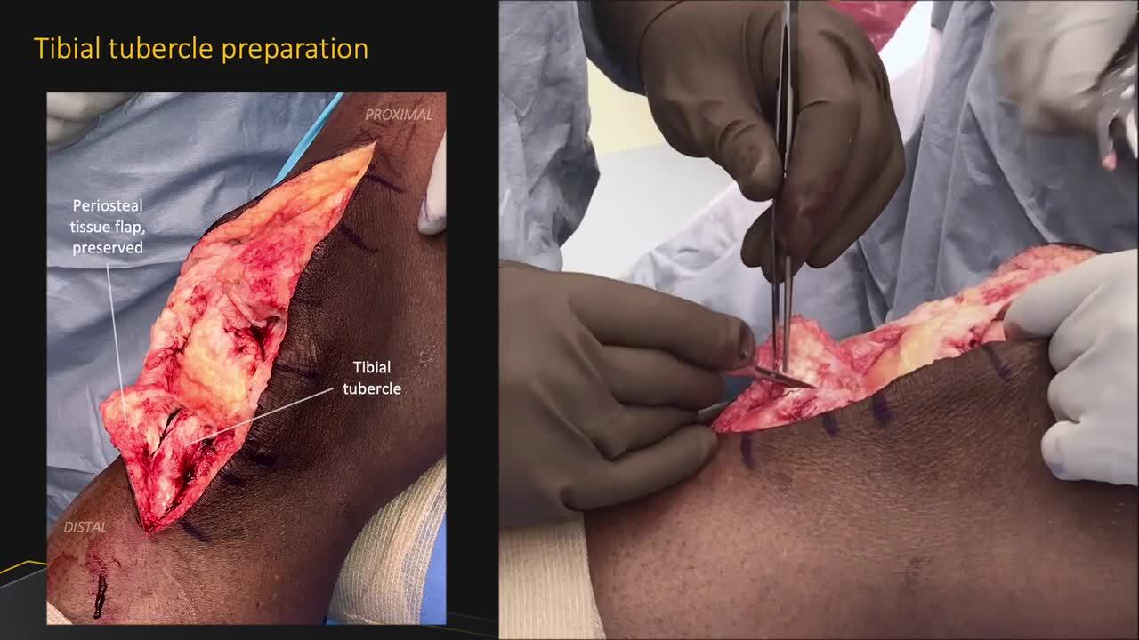 Patellar tendon reconstruction using Achilles tendon allograft. (A)