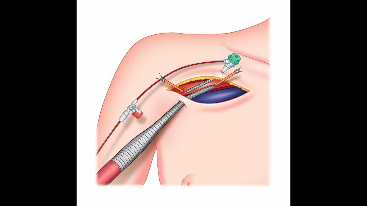 Venoarterial Extracorporeal Membrane Oxygenation via Direct Axillary Artery  Cannulation - Aakash Shah, Ronson J. Madathil, Bartley P. Griffith, David  J. Kaczorowski, 2021