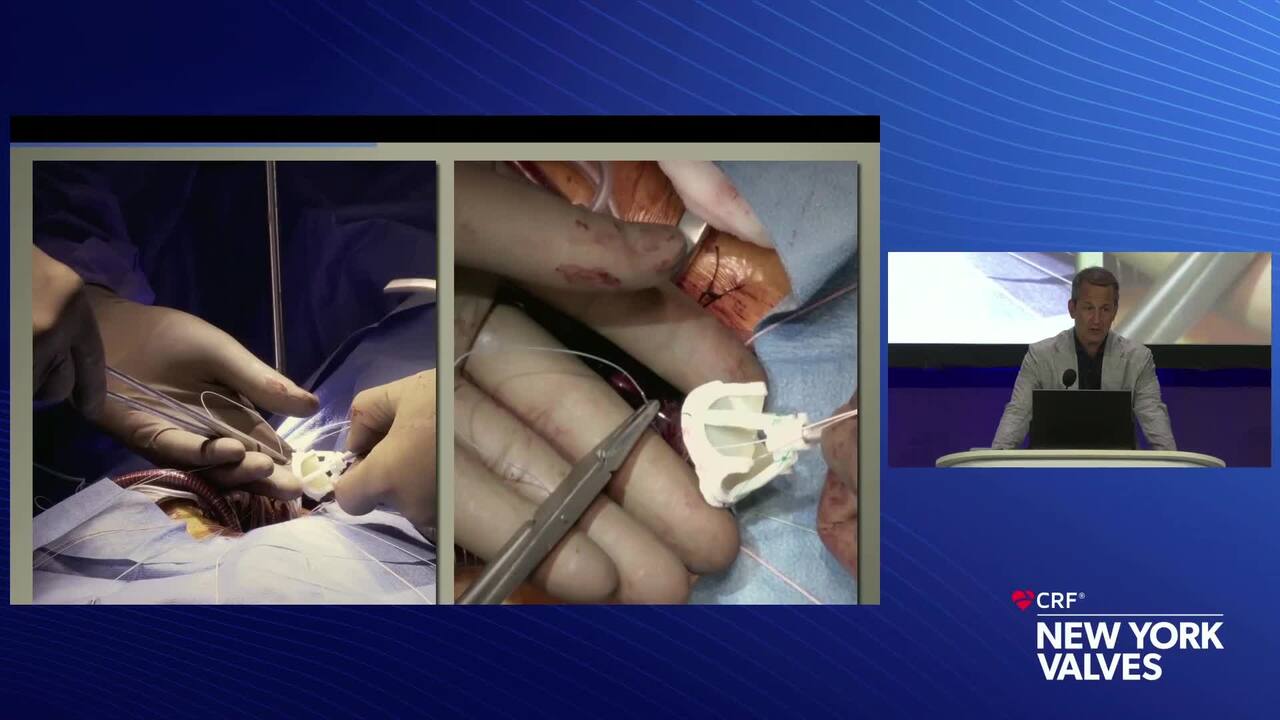 Live Case 8- Bicuspid AS-TAVR and Surgery_Live Pre-Recorded Case Presentation 1- Leipzig Heart, Leipzig, Germany-