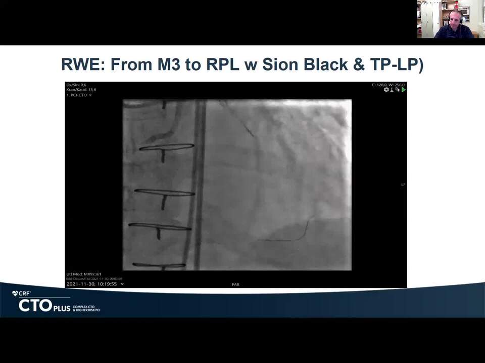 A Complex, RCA CTO PCI of the Distal Bifurcation in Two Attempts