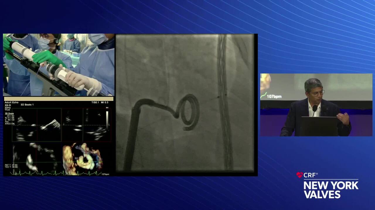 Live Case 14- New TMVR Technology_Live Pre-Recorded Case Presentation- Tioga TMVR - Tbilisi Heart and Vascular Clinic, Tbilisi, Georgia