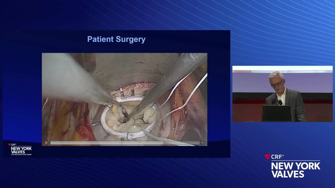Live Case 15- Mitral Chordal Repair - Surgical and Transcatheter_-Live Pre-Recorded Case Presentation 1- Surgical Chordal Repair - Bordeaux University Hospital, Bordeaux, France
