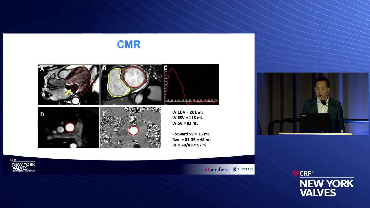 Assessment of Procedural Outcomes in Mitral TEER: Challenges and Unmet Needs