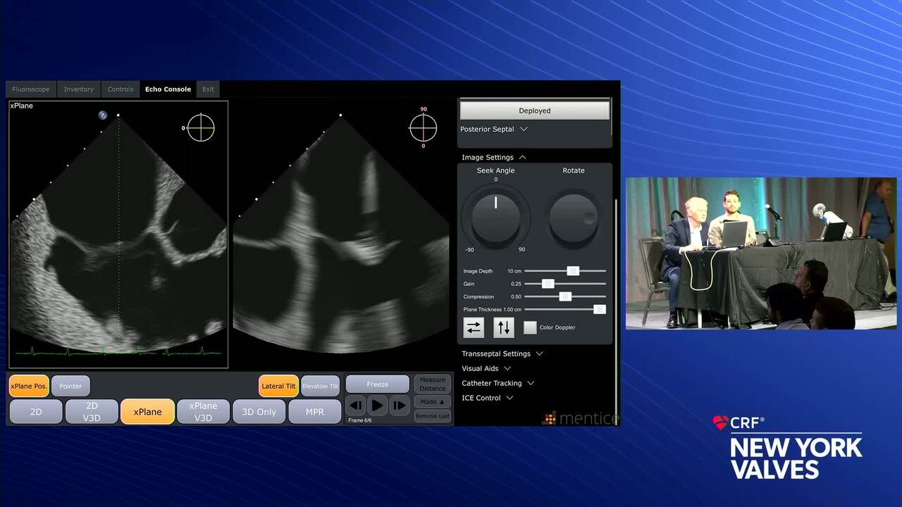 3D ICE Simulation: Tricuspid TEER