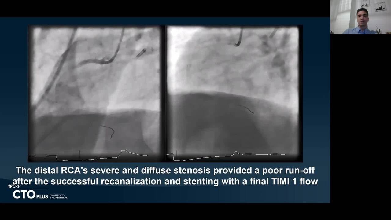 Drug-Eluting Balloon Angioplasty in Chronic Total Occlusions to Improve the Distal Vessel